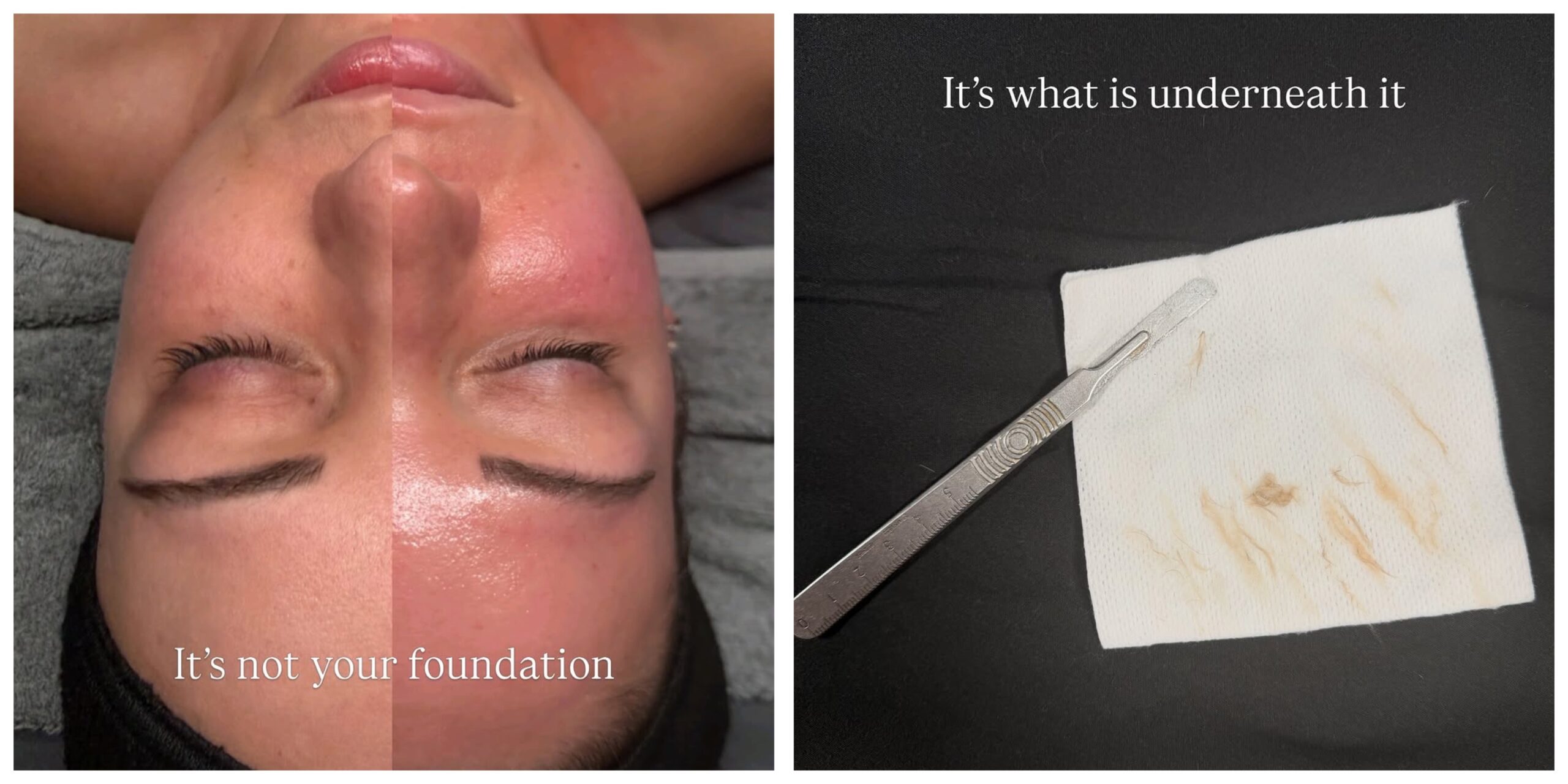 esthetician performing a facial treatment in Fort Wayne for clear, glowing skin